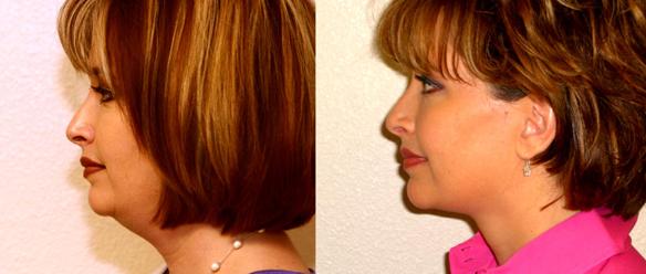 liposuction of the neck